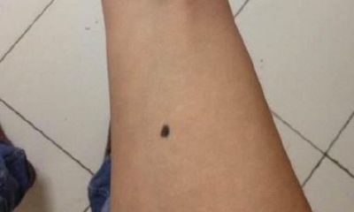 男人手臂有痣解说