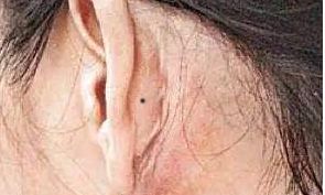 耳背有痣代表什么