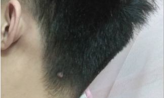 后脑勺长痣的人的运程 后脑勺有痣代表什么