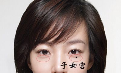男人眼袋有痣代表什么