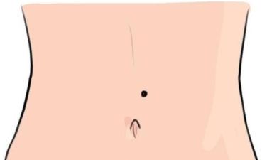 肚子痣相图解大全