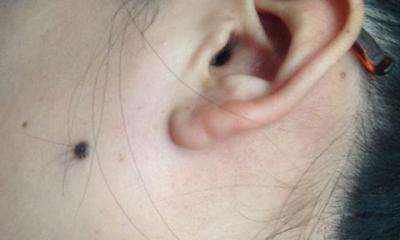痣上长毛很长可以剪吗，痣上长毛能剪掉吗
