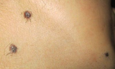 痣长毛可以拔掉吗，痣上长毛能拔吗