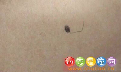 黑痣上长毛代表什么，黑痣长毛好还是不好