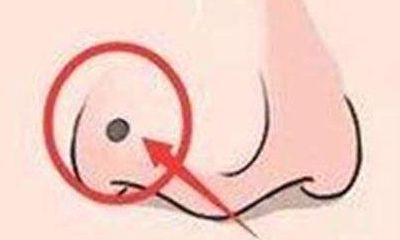 男人鼻翼有痣代表什么