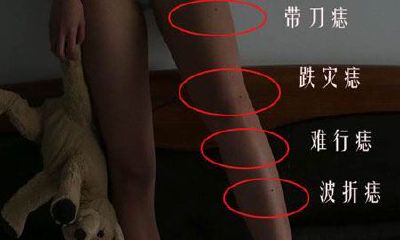 女人腿部痣相图解