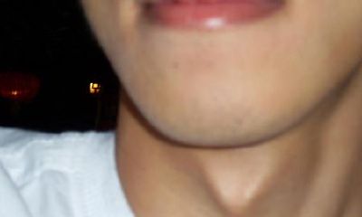 喉结下方有痣代表什么