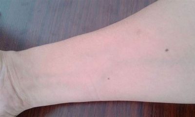 手臂黑痣代表什么