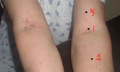 肘关节有痣代表含义