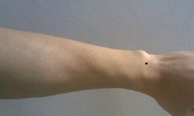 男人手腕部位有痣