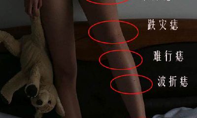 腿弯有痣代表什么