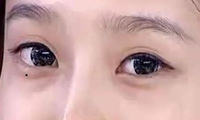 女人右眼下眼袋有痣代表什么
