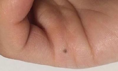 手掌有黑痣是什么含义