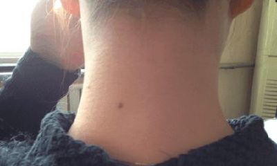 为什么很多人的脖子后面都有一颗黑痣