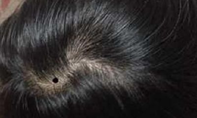 痣的位置：头顶部