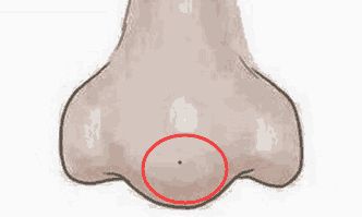 暴富痣, 脸上四处吉痣, 有一种就能身家百万