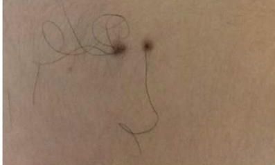 解读痣上长毛是怎么回事？