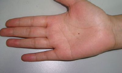 手上长痣面相图，手心长痣好不好