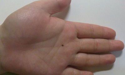 左手手掌有痣代表什么
