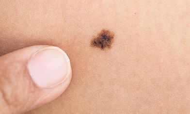 身上长痣是什么征兆