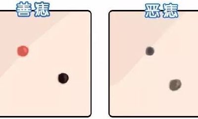 什么是善痣 什么是恶痣