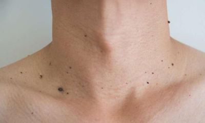 痣的含义：在脸部和身体上