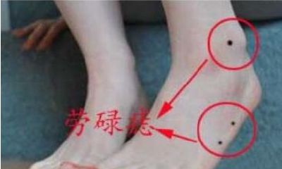 脚侧面、脚踝有痣代表什么