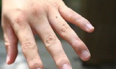 左手无名指上的痣