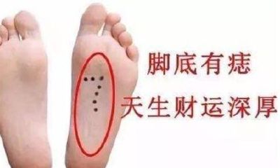 脚底长痣命运是好不好