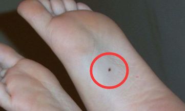 脚上有痣图解 脚上有痣全解析
