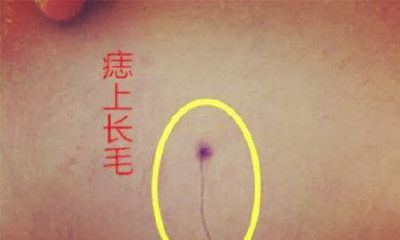 痣上长毛代表什么，有什么寓意？