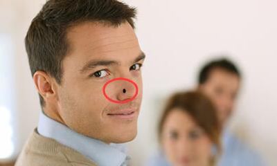 面部哪些地方长痣的人适合去外地工作