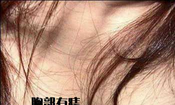 面部手足开运痣相补贴