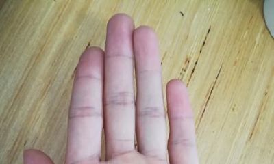 女性左手手掌长痣图解分析 手中痣的解释