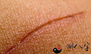 梦见伤口愈合好了