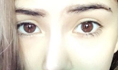 “绿帽痣”可以点掉吗