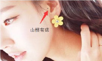 一定得点的3种痣