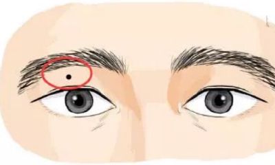 倒霉痣，四处长恶痣，钱财散尽，婚姻不顺，点掉不可留