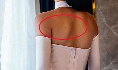 不同位置的痣代表的不同含义