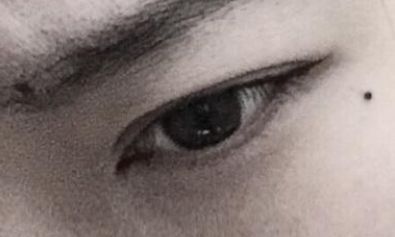 痣不要乱点，一年点痣不要超过三颗