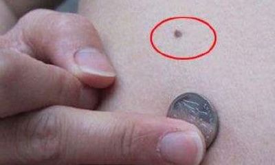 背上长一痣，巨富痣，无论男女