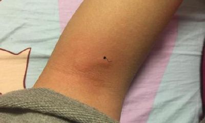 胳膊痣上长毛，剪掉好吗？有什么影响？