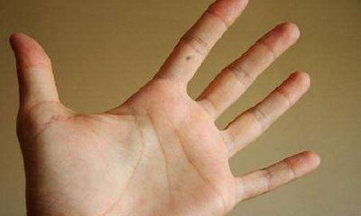 男性左手食指上有痣代表什么，男人左手食指上有痣好不好