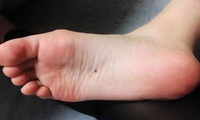 右脚底痣图 右脚底痣代表什么