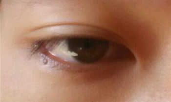 眼睛周围所具有的痣