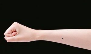 盘点手臂的活痣