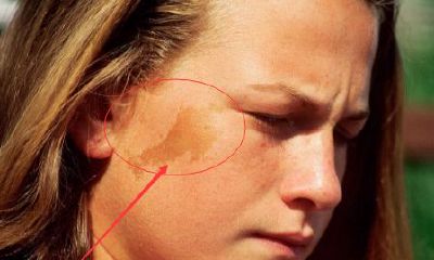 脸上长胎记的命运，脸上哪里有胎记最好命