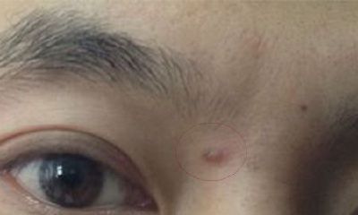 痦子和痣的区别图解