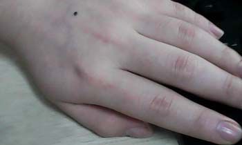 左手手背上有痣图解