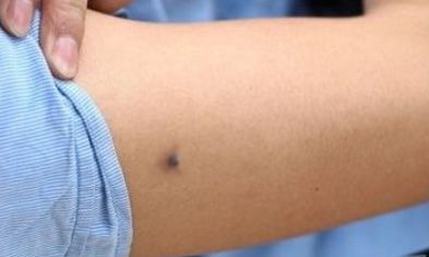 女性手臂长痣面相图解 了解不同痣的特点